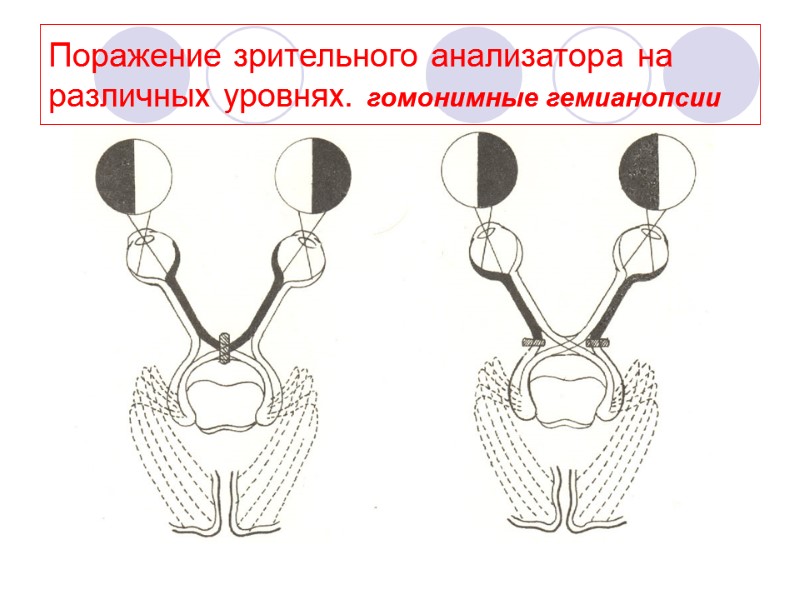 Поражение зрительного анализатора на различных уровнях. гомонимные гемианопсии